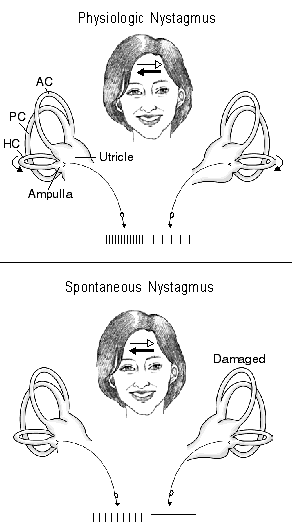 This figure shows nerve activity associated with rotational-induced physiologic nystagmus and spontaneous nystagmus resulting from a lesion of one labyrinth.